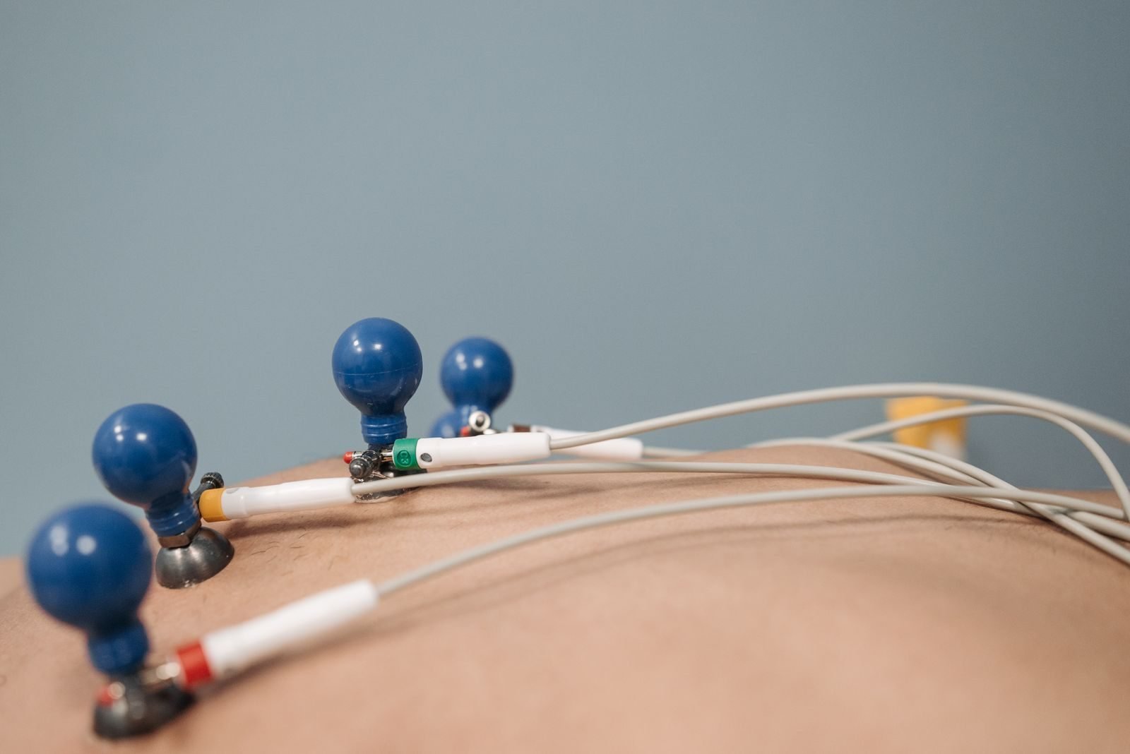 ECG electrodes placed on a patient chest